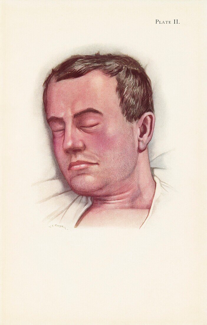 Phosgene patient in World War One, illustration