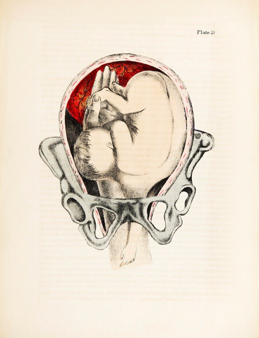 Shoulder presentation birth, 19th century illustration