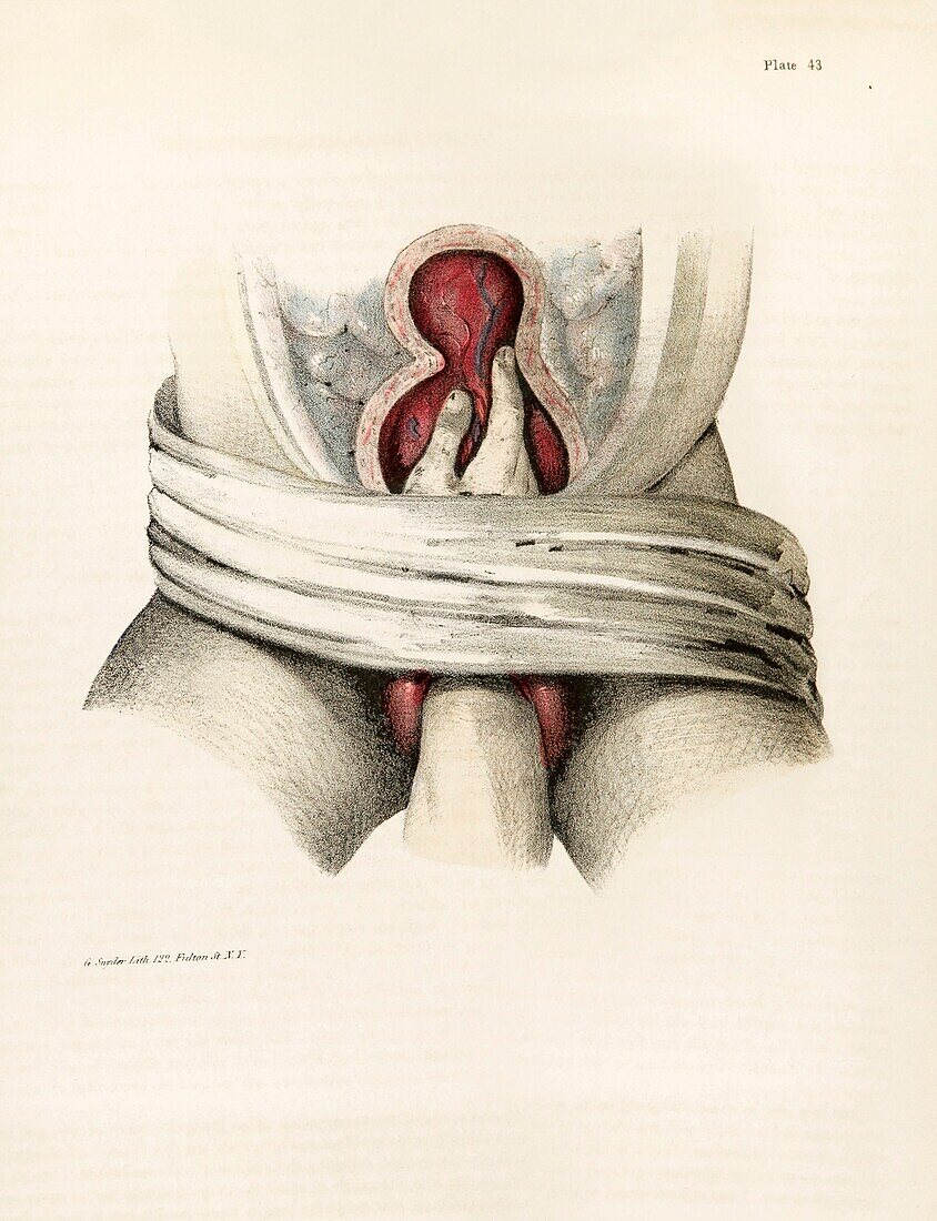 Extracting retained placenta, 19th century illustration