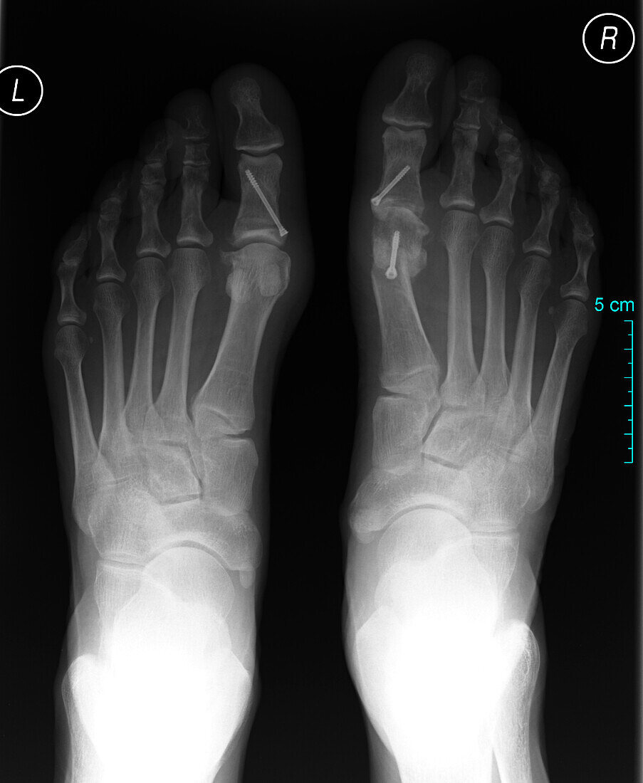 Pinned big toes, X-ray