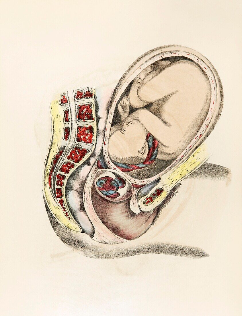 Placenta previa, 19th century illustration