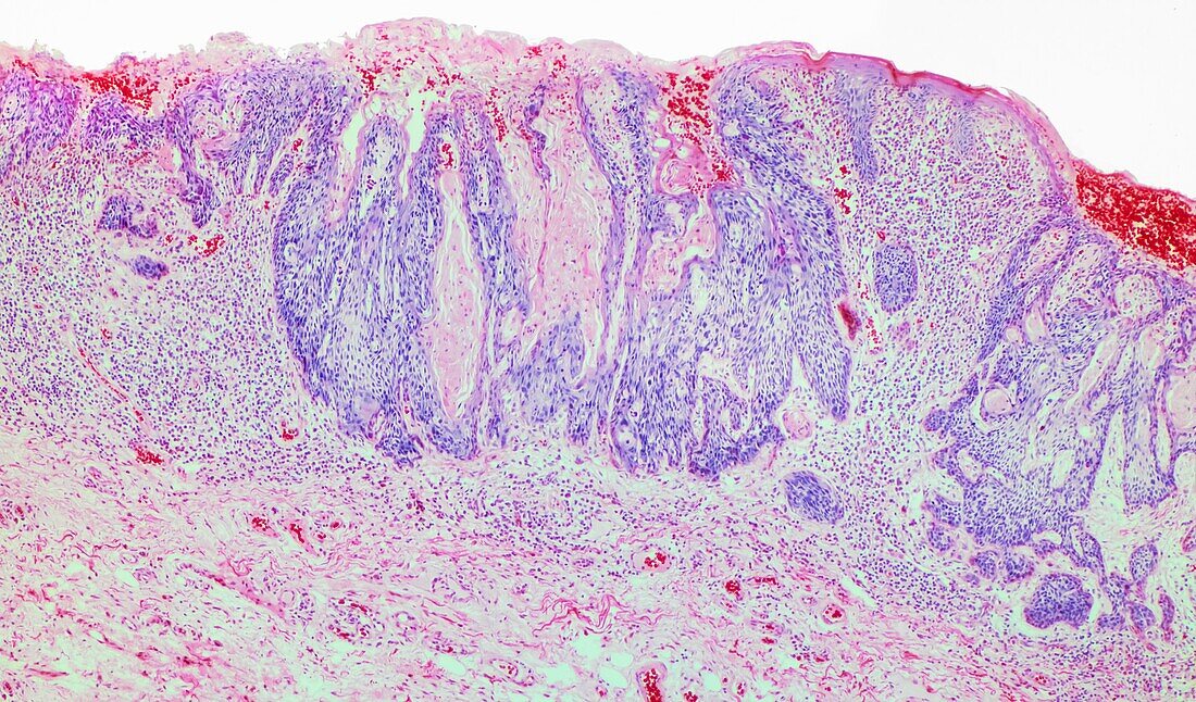 Squamous cell carcinoma, LM