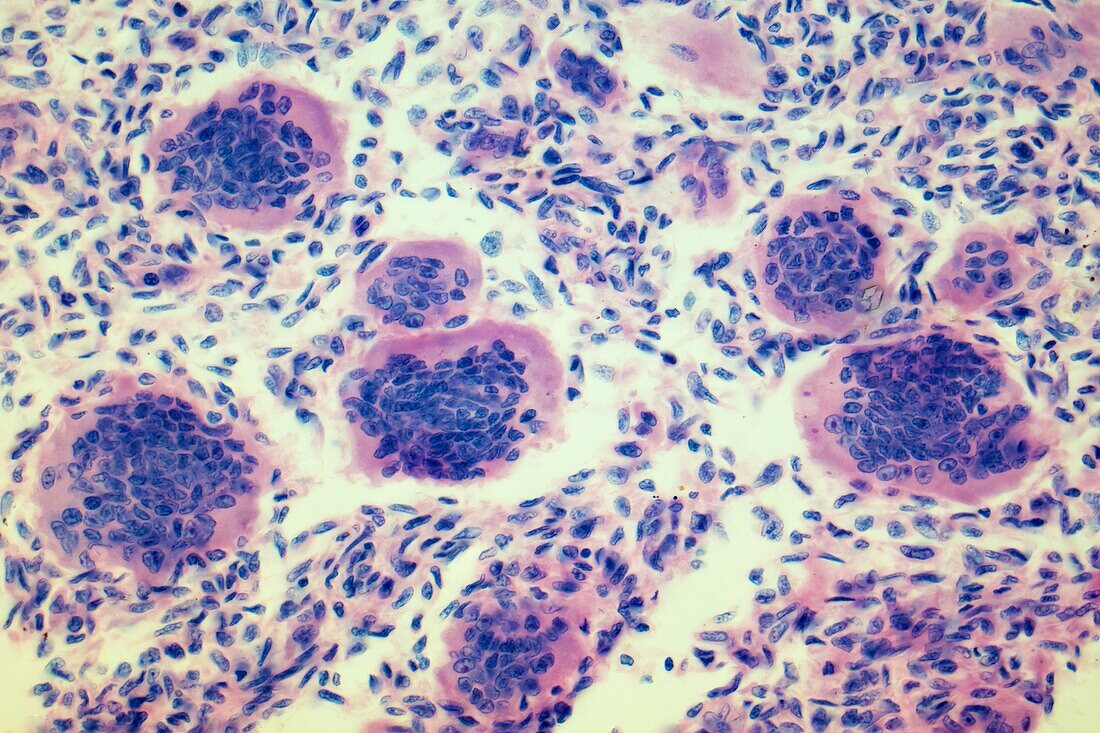 Giant-cell bone tumour, LM