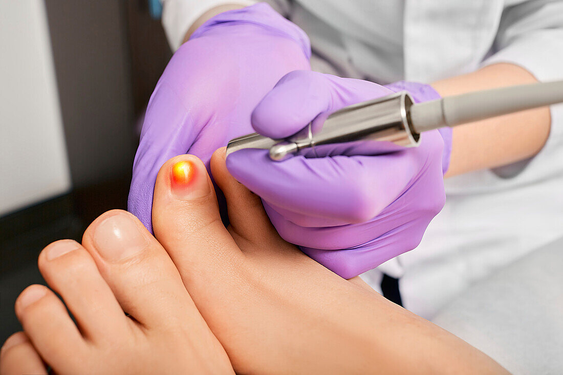 Fungal toenail infection laser treatment