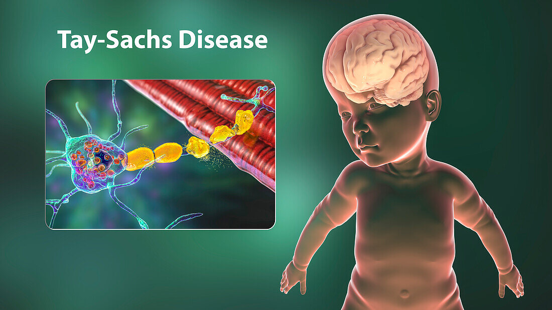 Tay-Sachs disease, computer illustration