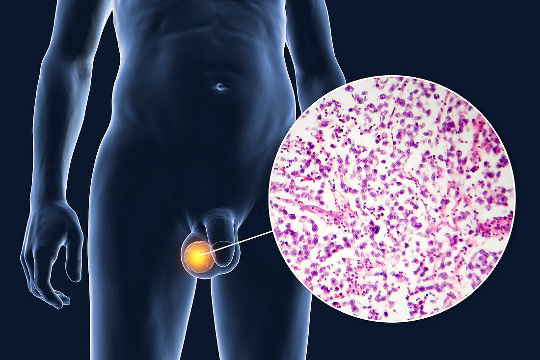 Testicular cancer, illustration and light micrograph