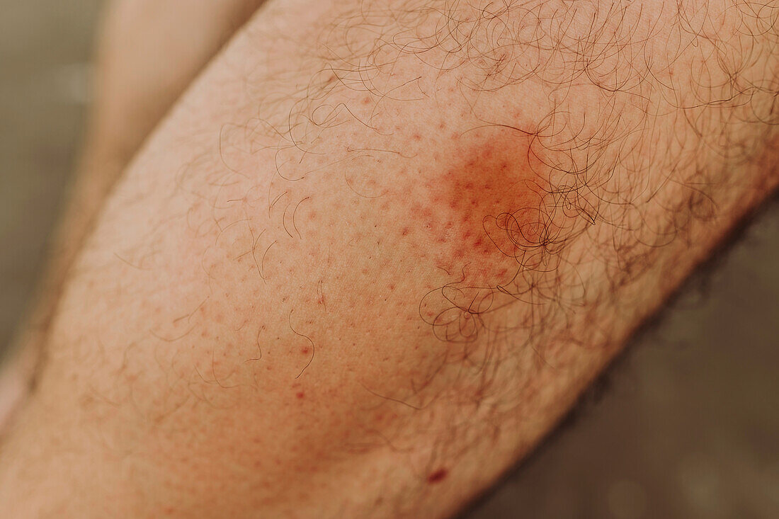 Fly bite mark on leg