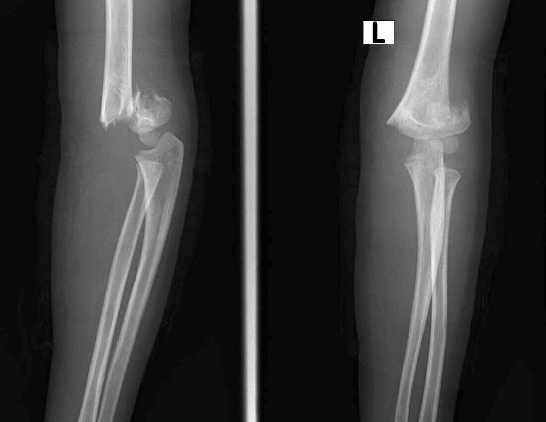 Supracondylar humerus fracture, X-ray