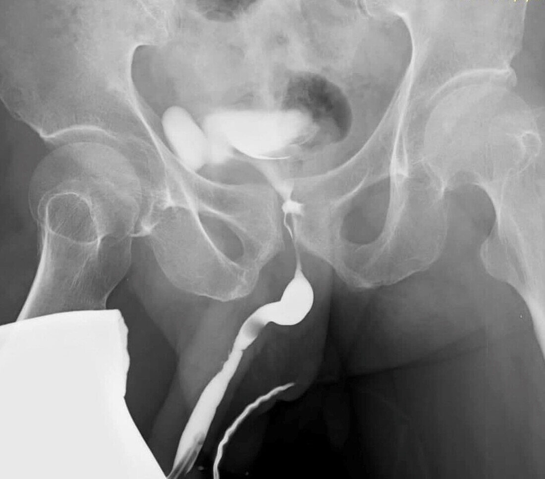 Narrowed urethra, X-ray