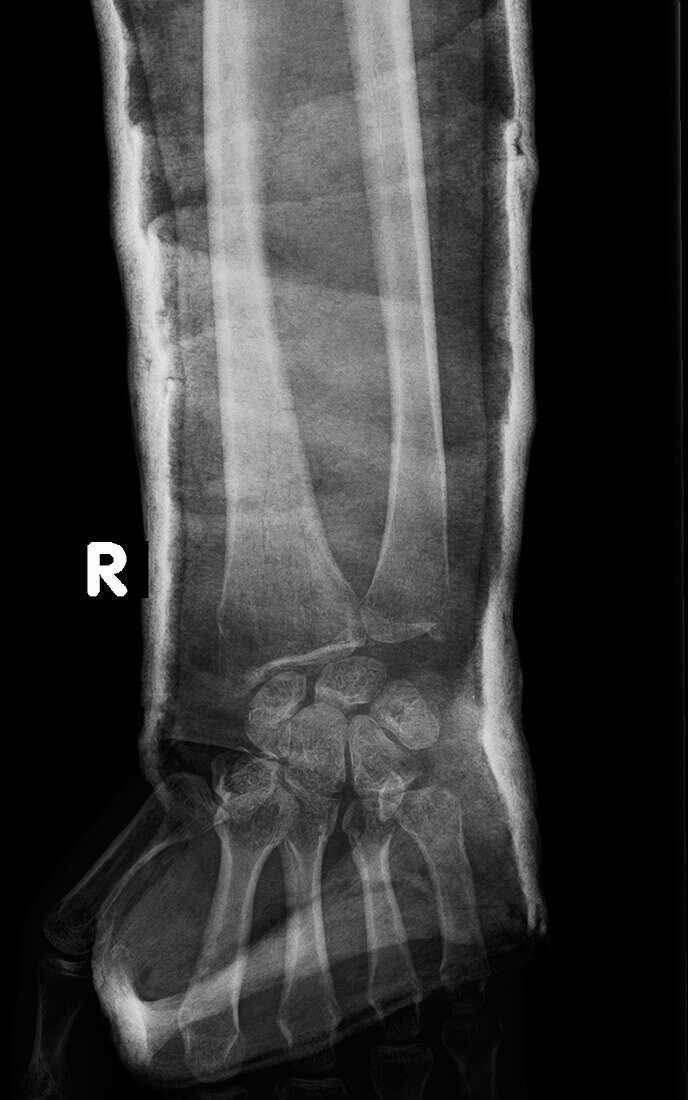 Fractured hand in cast, X-ray