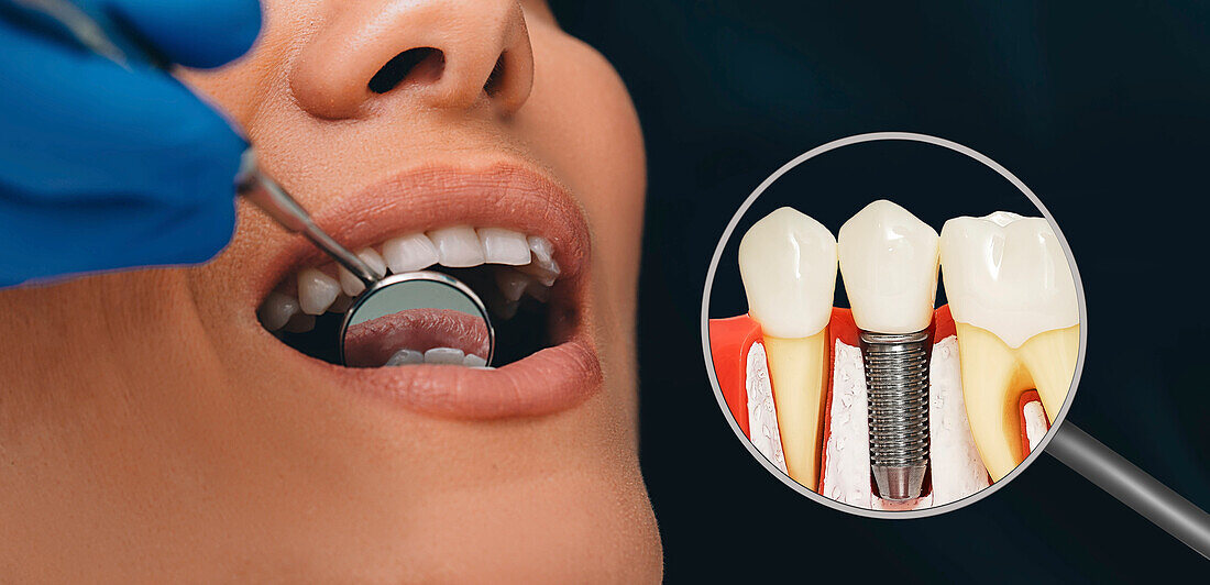 Dental implant, composite image