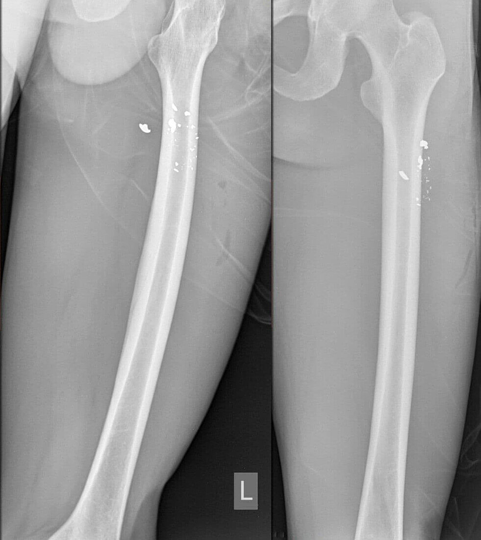 Gun shot in thigh, X-ray