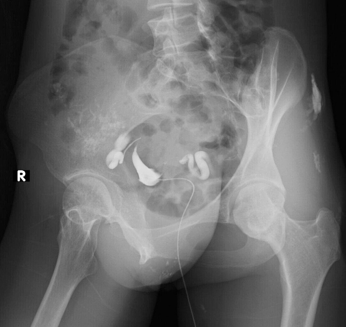 Swollen fallopian tubes, X-ray