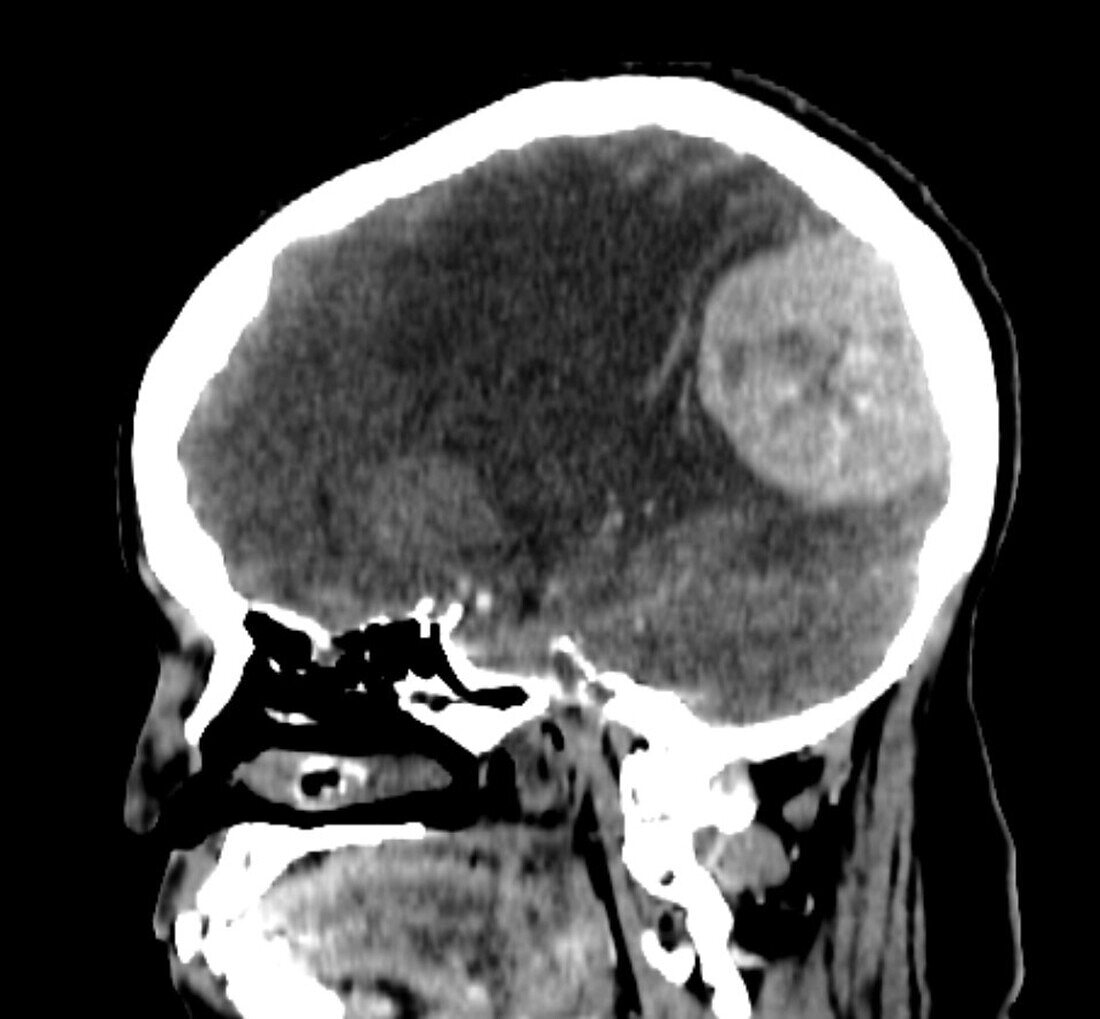 Meningioma, CT scan
