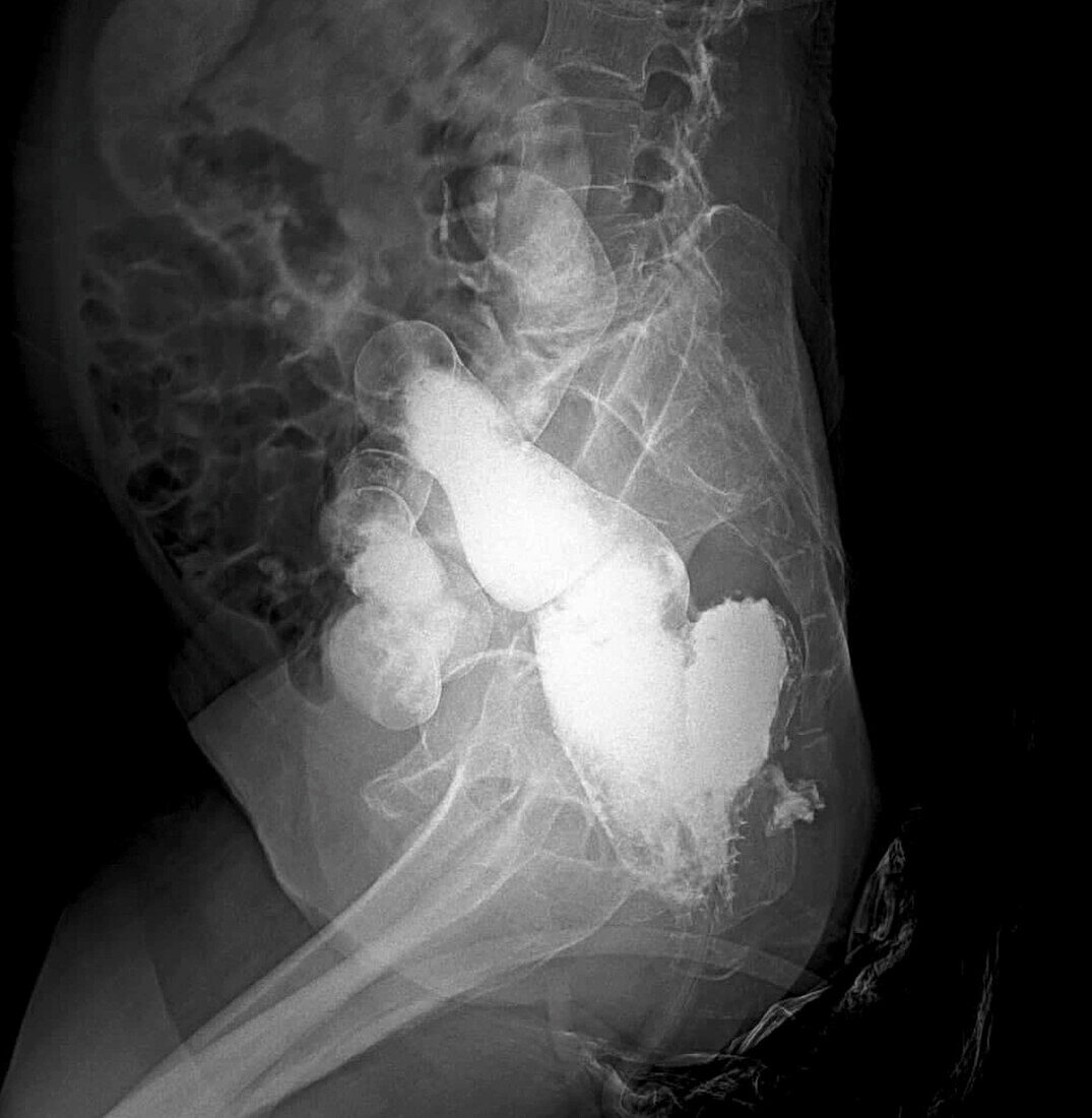 Rectal diverticulum and proctitis, X-ray