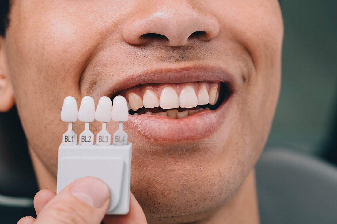 Teeth whitening sample colours
