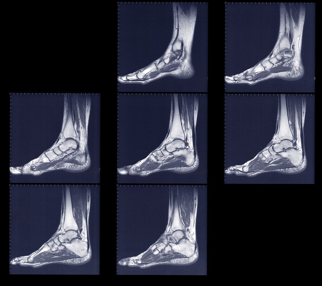 Scans of feet and ankles side, MRI