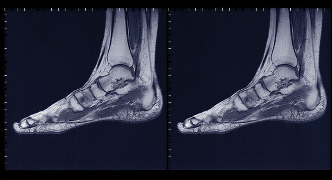 Foot and ankle, MRI