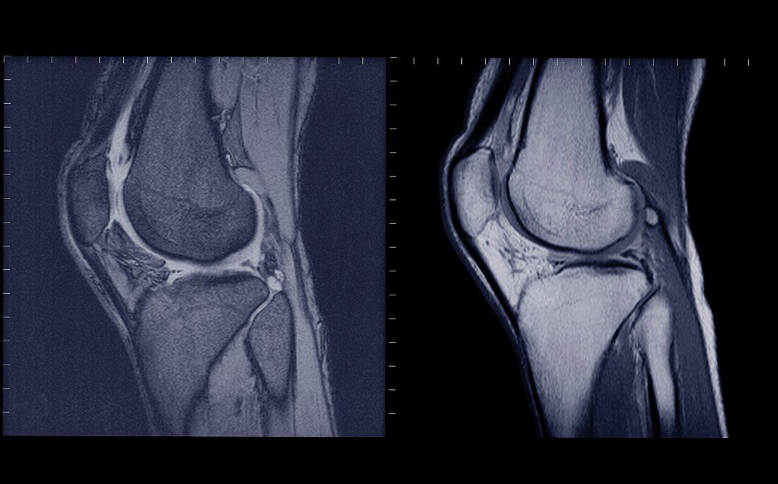 Knee joints side view, MRI