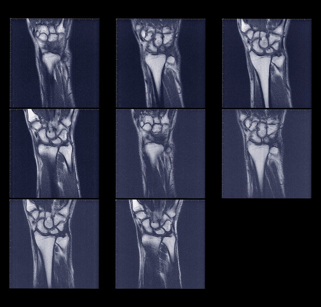 Multiple scans of wrist, MRI