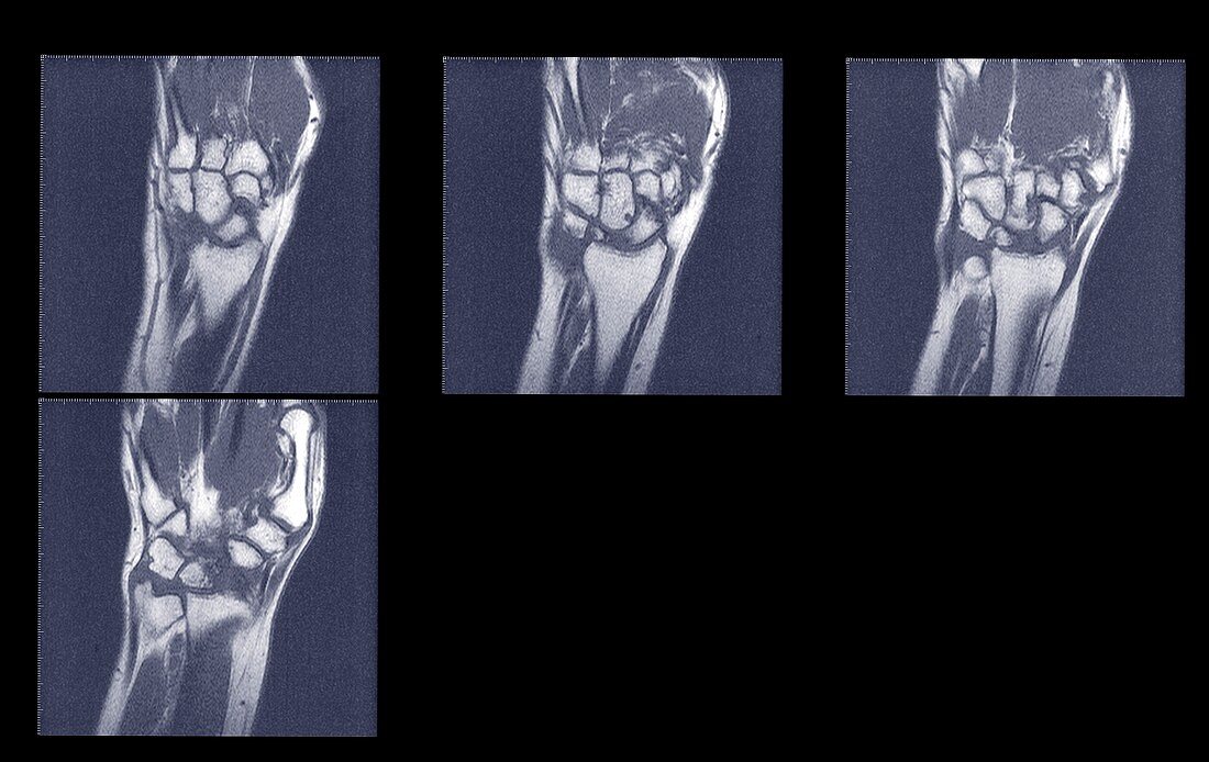 Scans of wrists, MRI