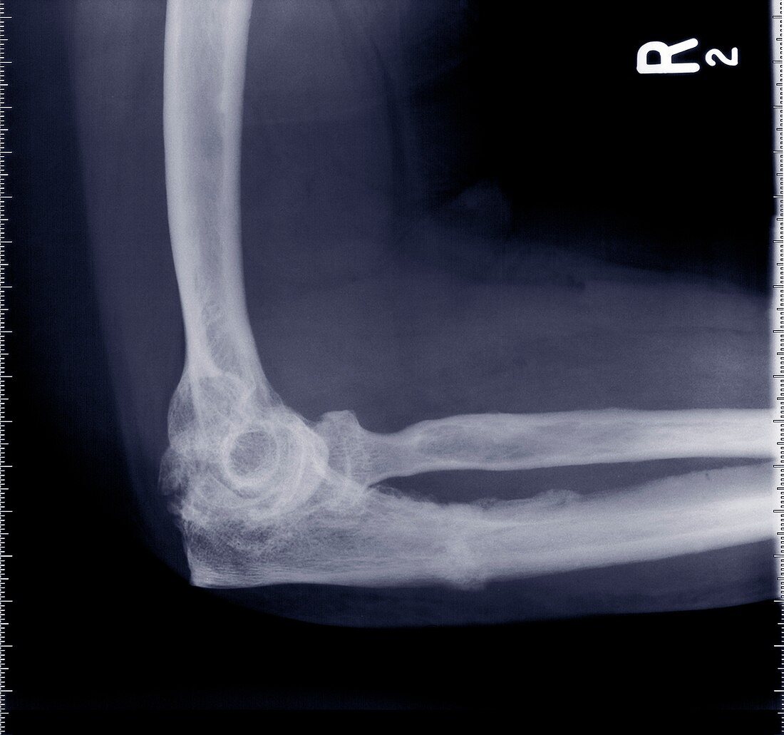 Elbow from side, X-ray