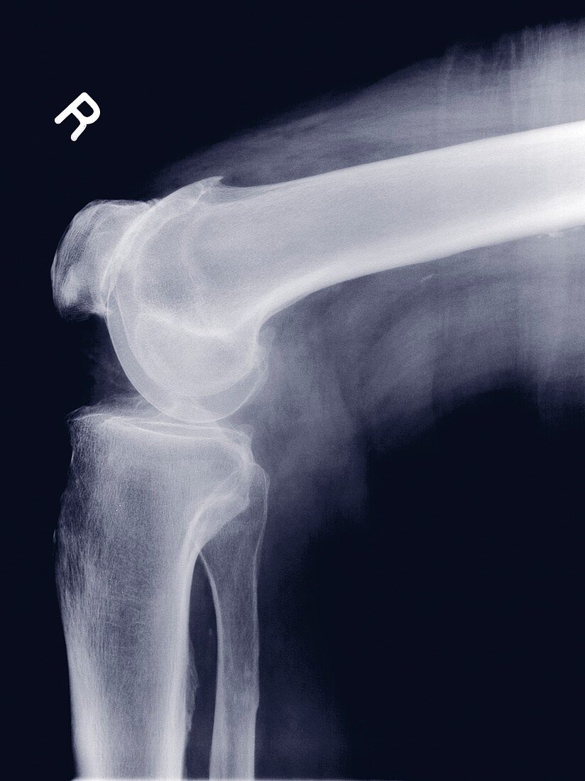 Right shoulder joint, X-ray
