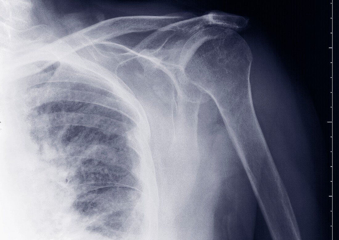 Shoulder, X-ray