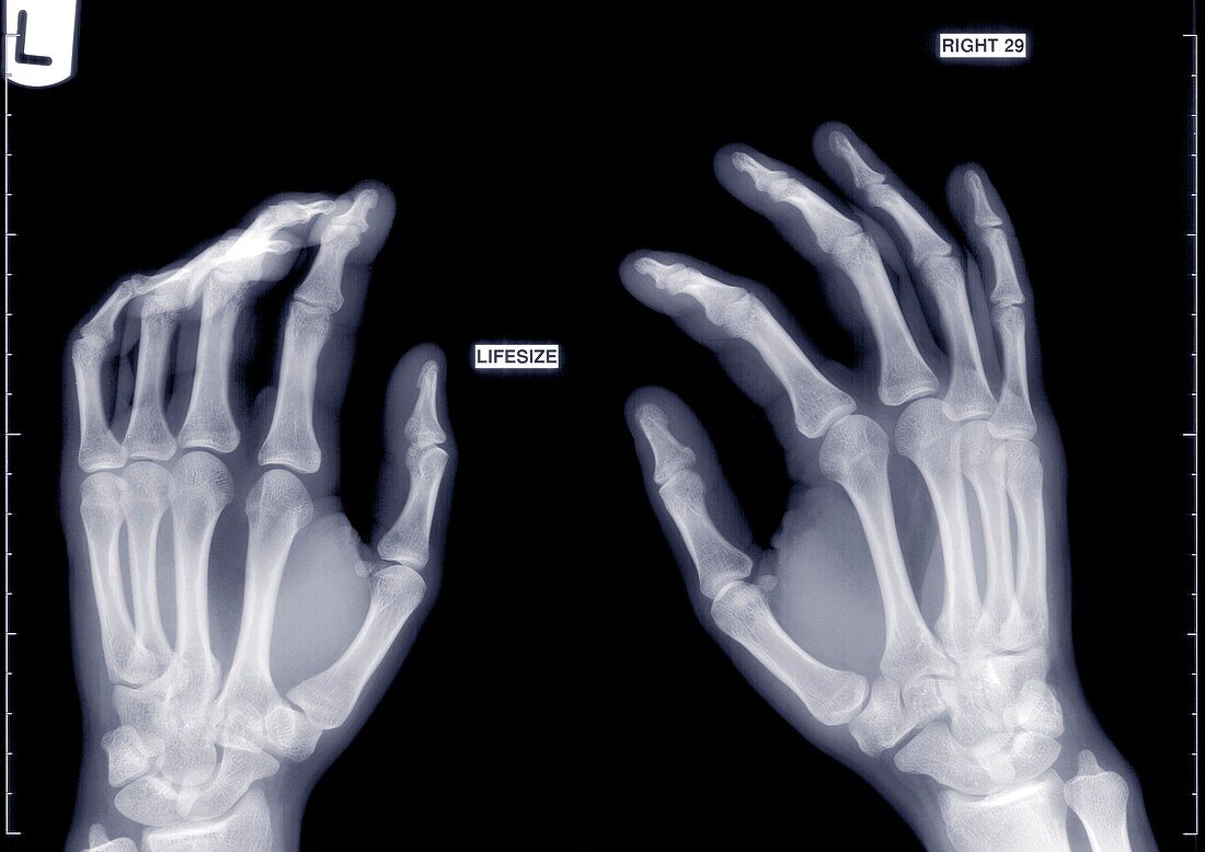 Hands slightly arched, X-ray
