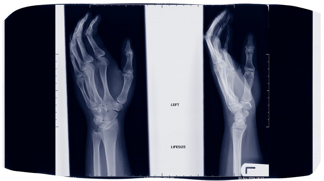 Film of two hands, X-ray