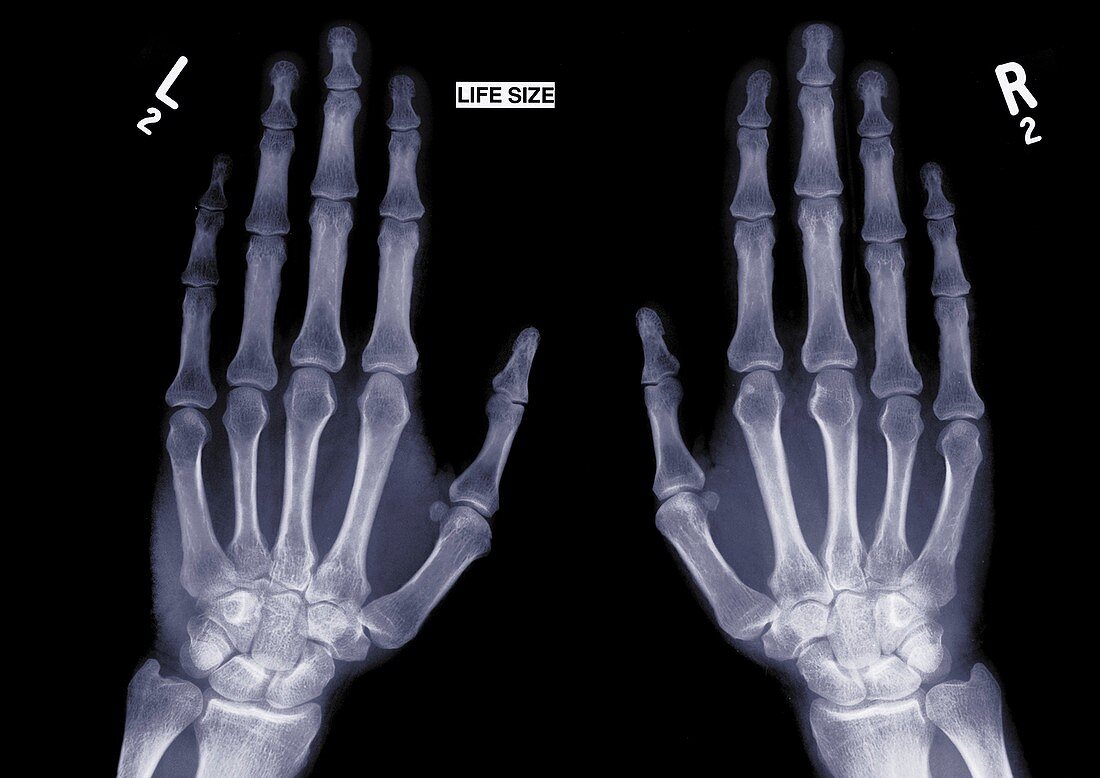 Two outstretched hands, X-ray