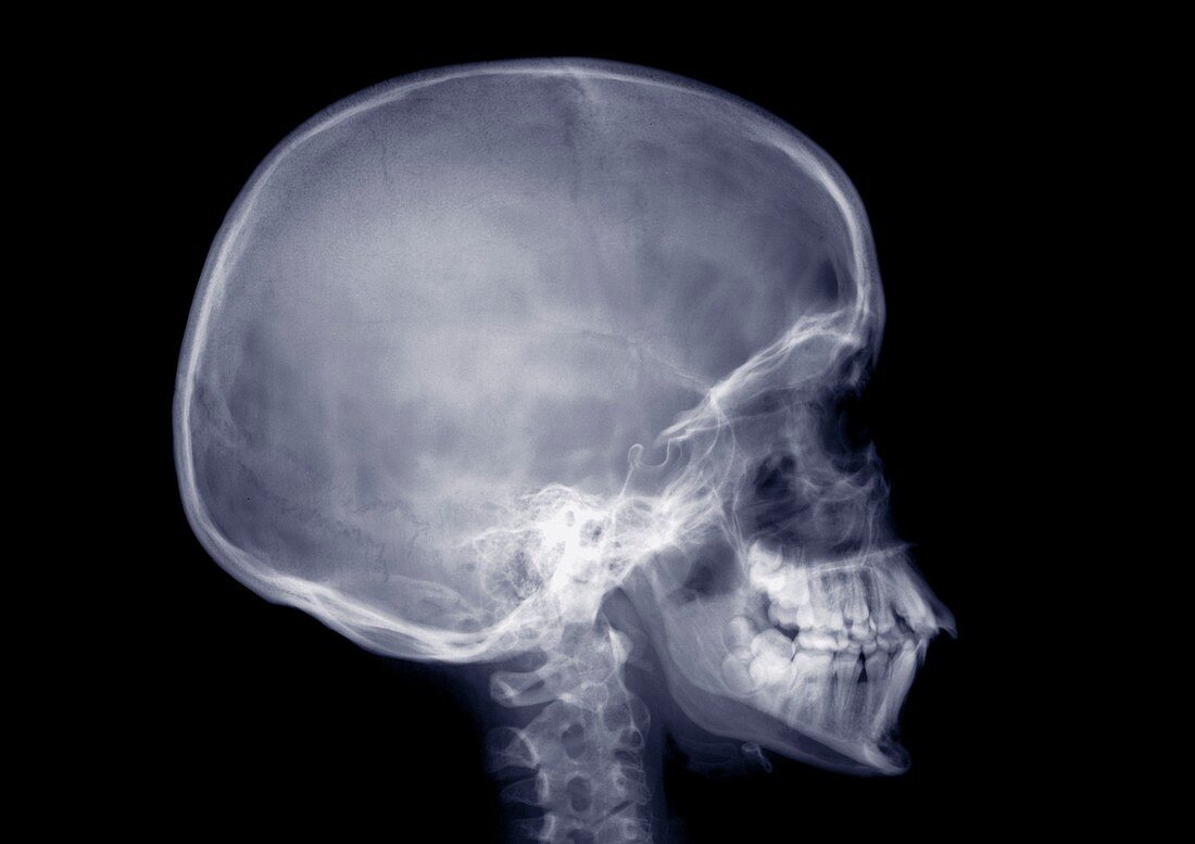 Human skull from side, X-ray