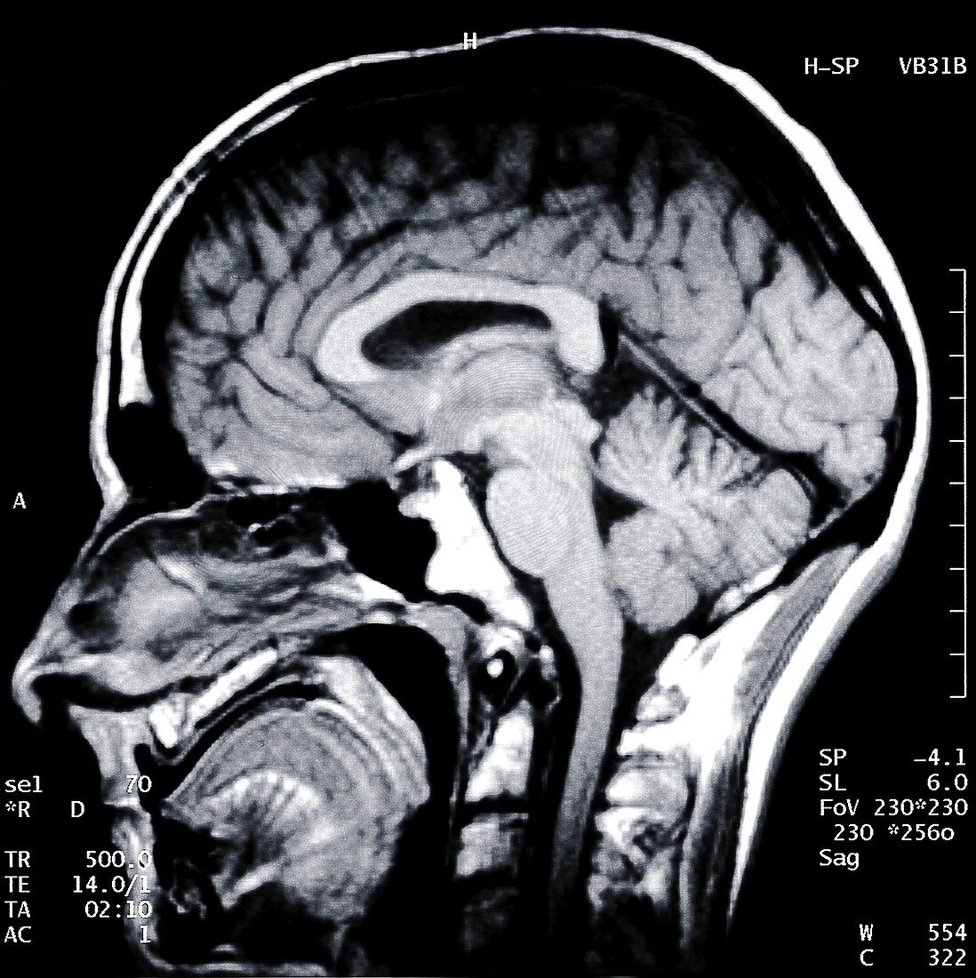 Brain and skull from side, X-ray