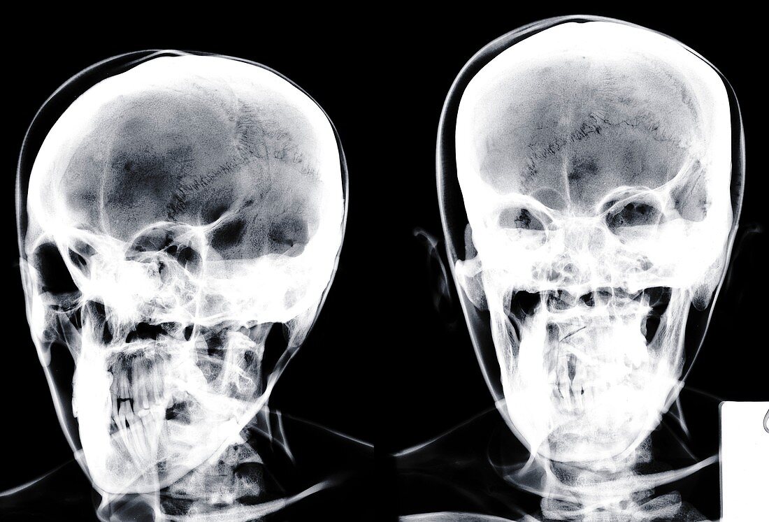 Two human skulls, X-ray