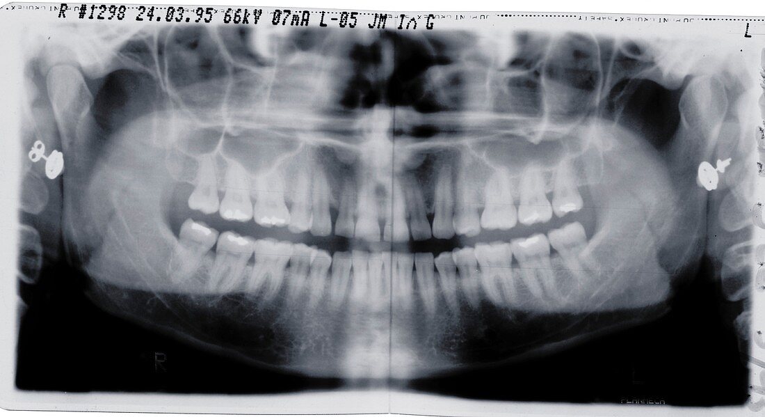 Teeth and jaw, X-ray