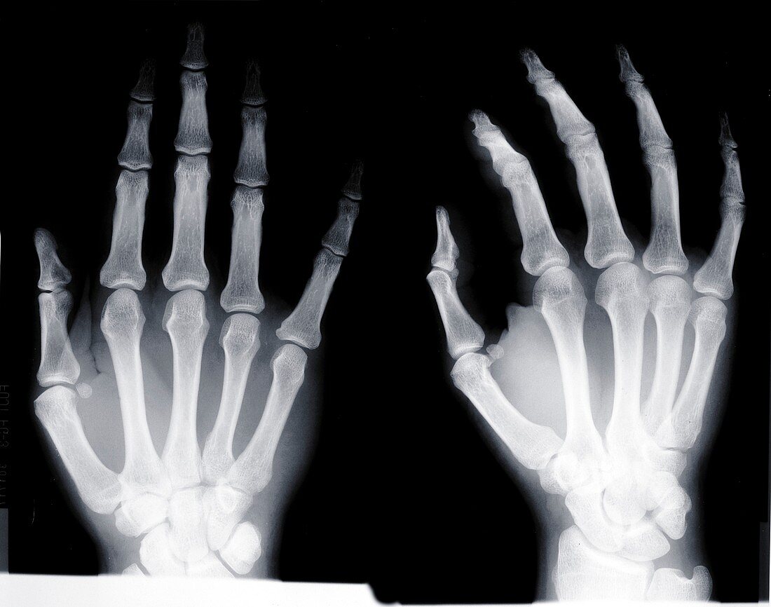 Human hands, X-ray