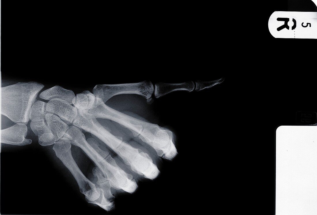 Human hand with thumb pointing, X-ray