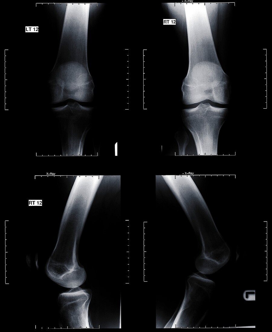 Human knee joints, X-ray