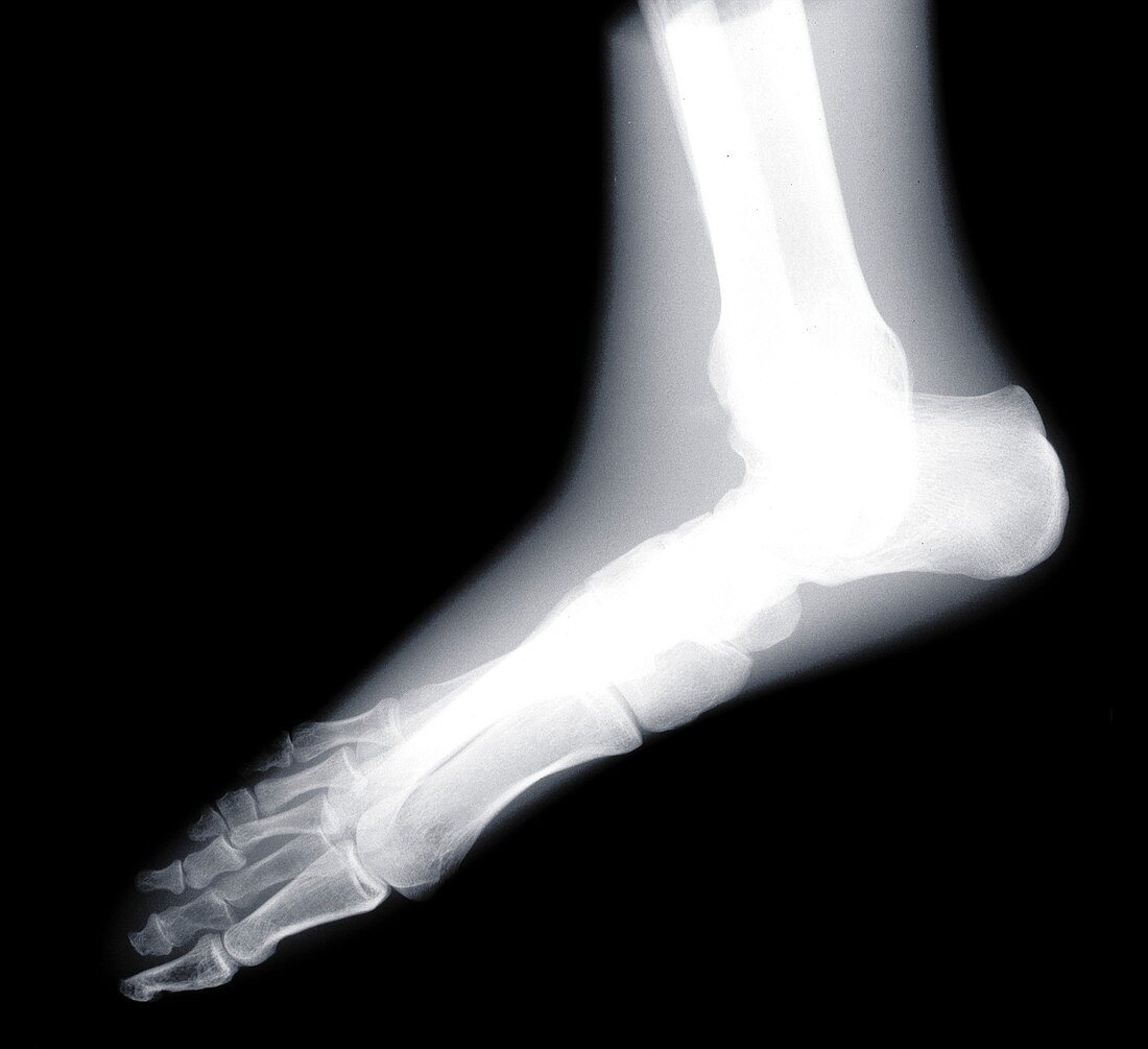 Human foot, X-ray