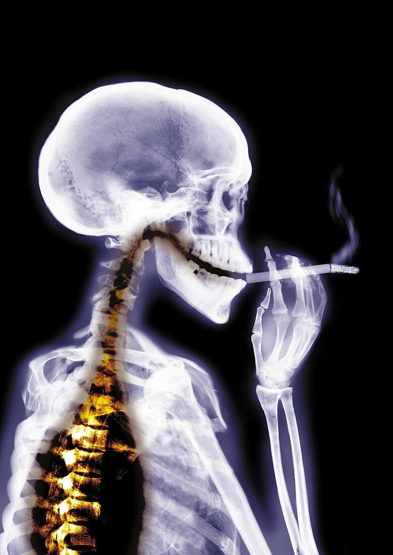 Person smoking, X-ray