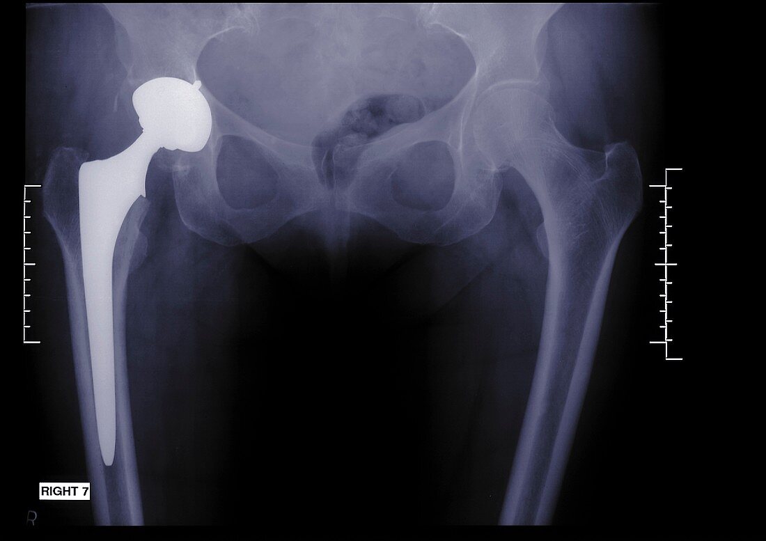 Person with an artificial hip, X-ray