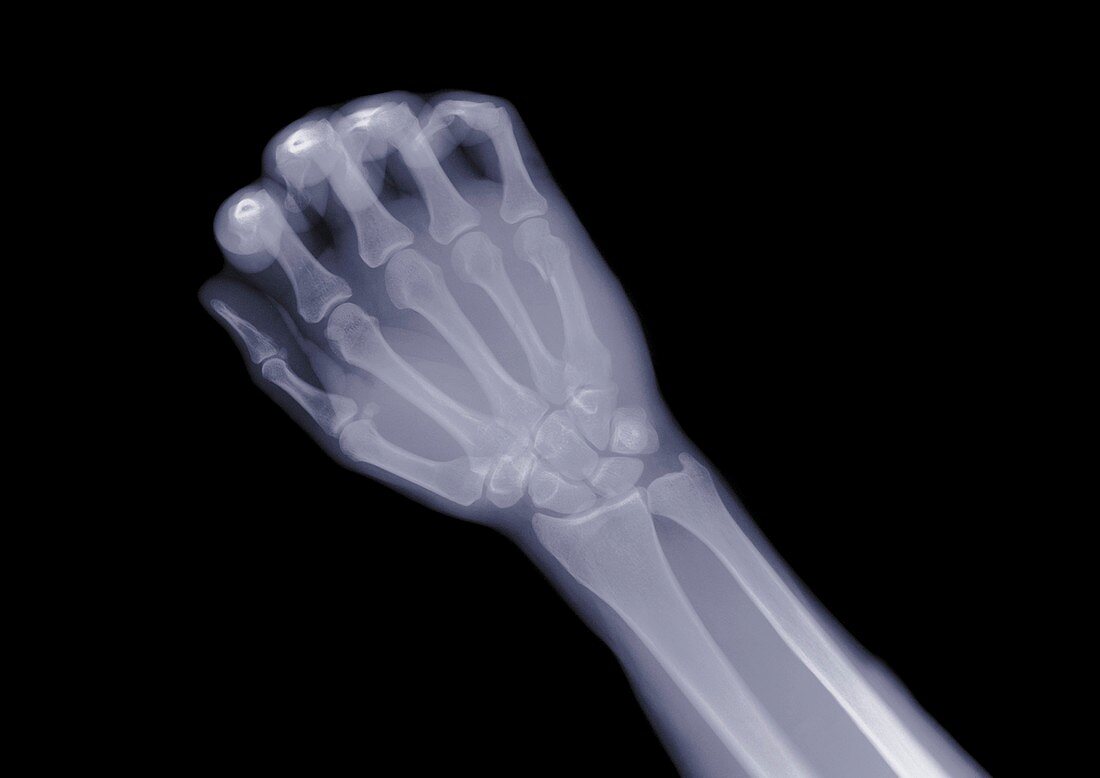 Closed fist, X-ray