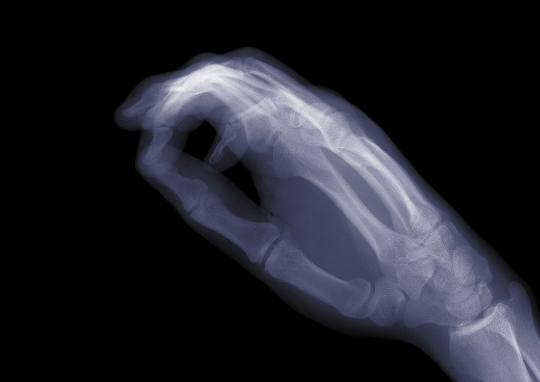Closed hand, X-ray