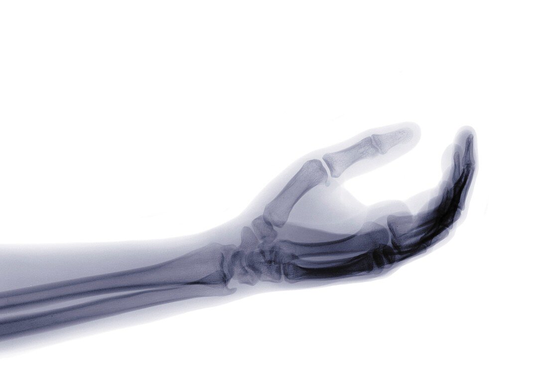 Arm and hand, X-ray