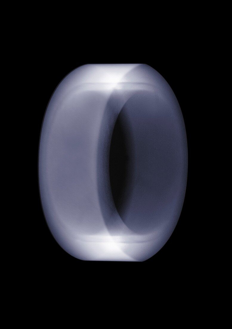 Metal ring, X-ray