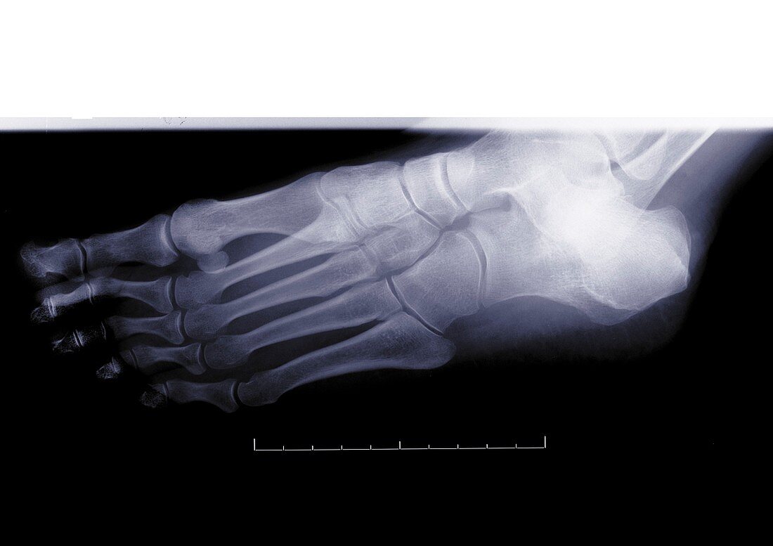 Foot, X-ray