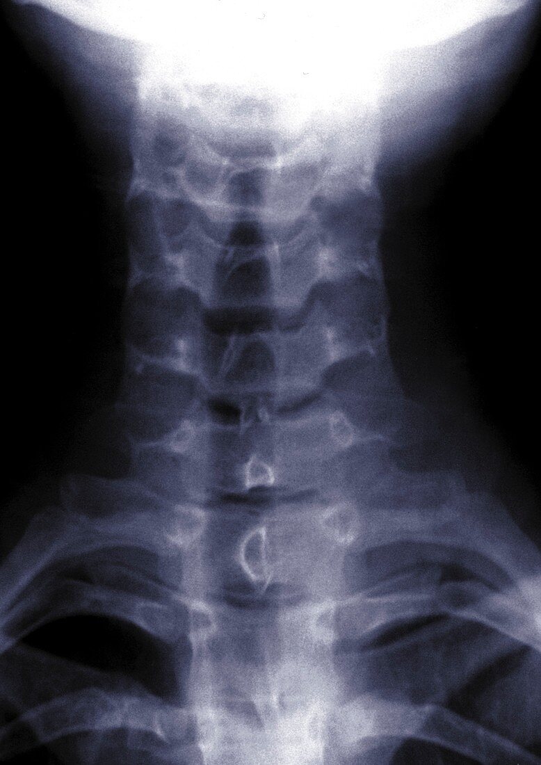 Vertebrae, X-ray
