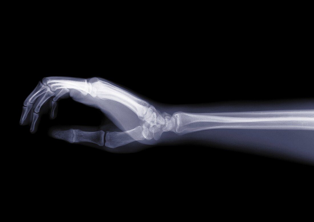 Arm and hand in profile, X-ray