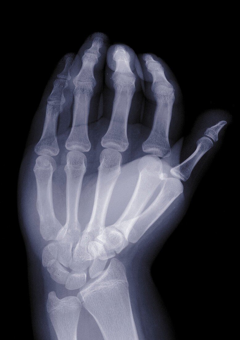 Hand shot from above, X-ray
