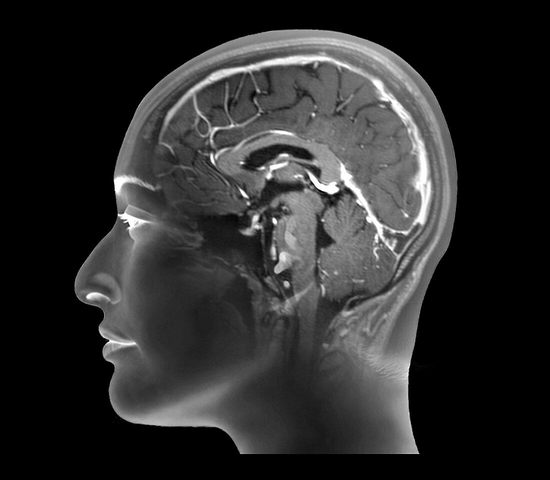Thrombophlebitis of the brain, MRI scan